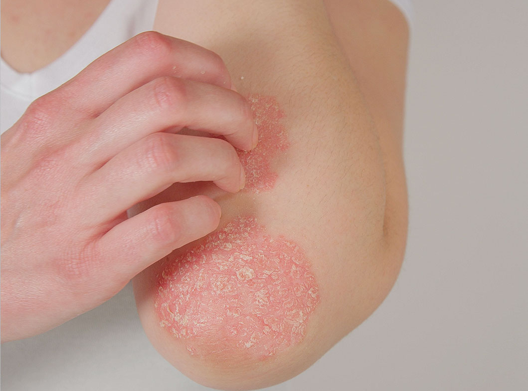 Acne Treatment Options Acne Treatment Options