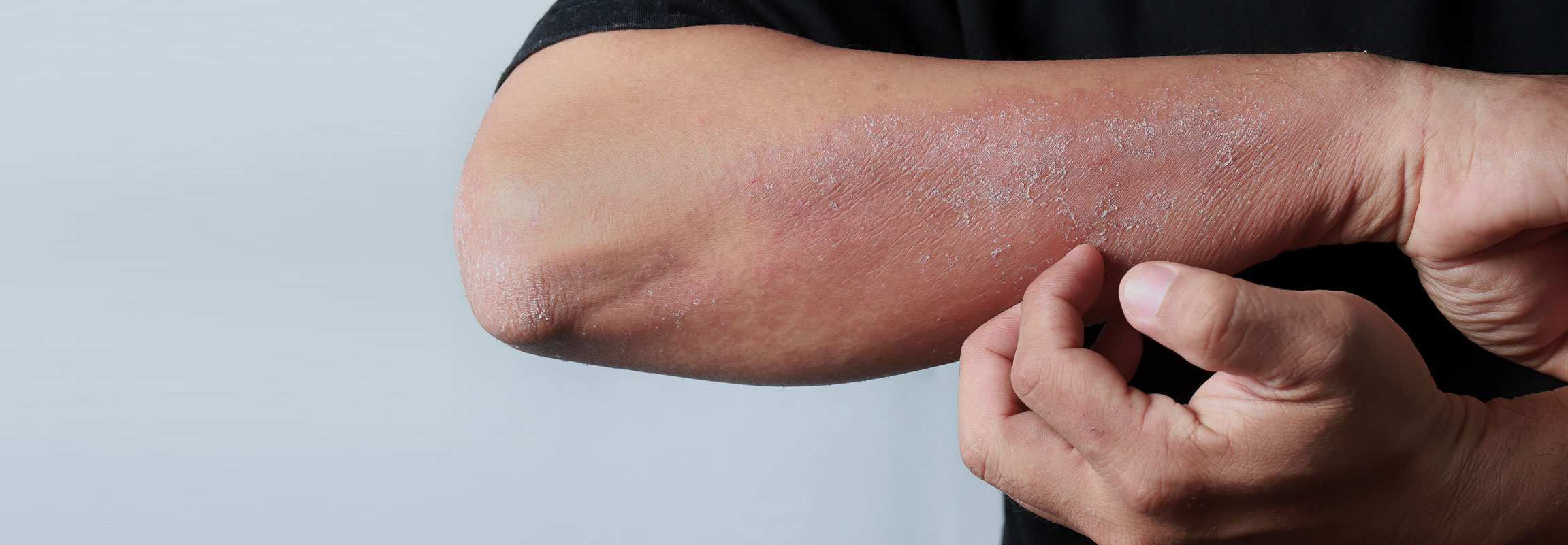 Understanding Psoriasis