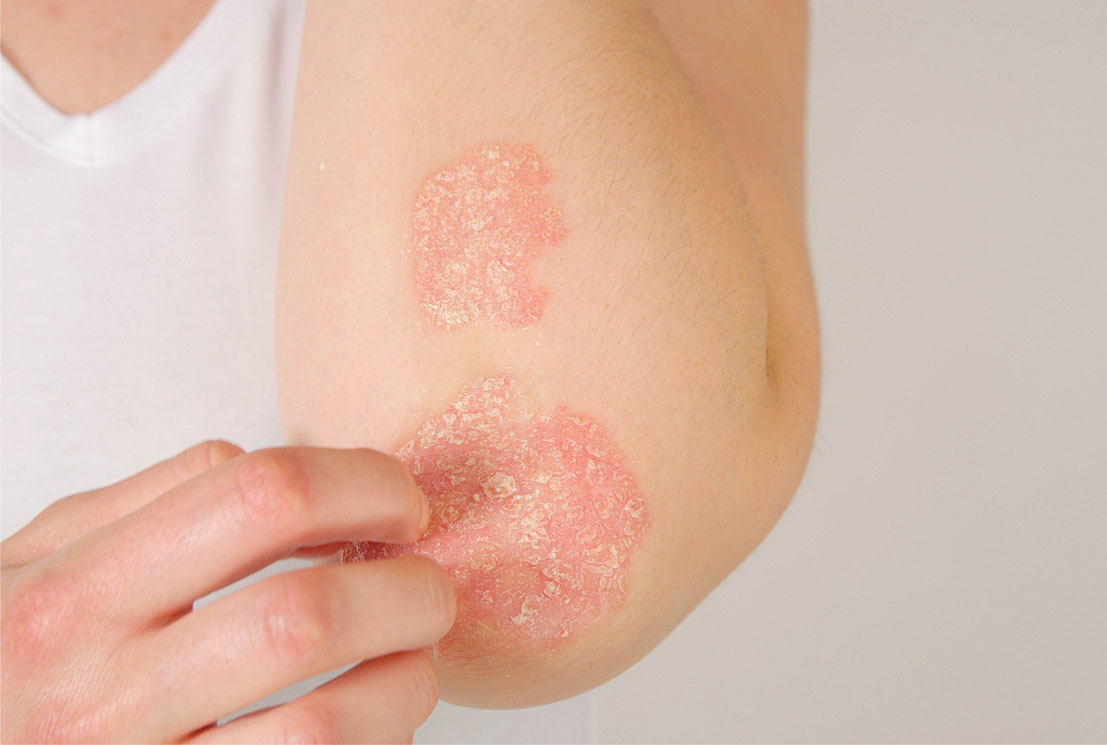 How Common is Psoriasis? How Common is Psoriasis?