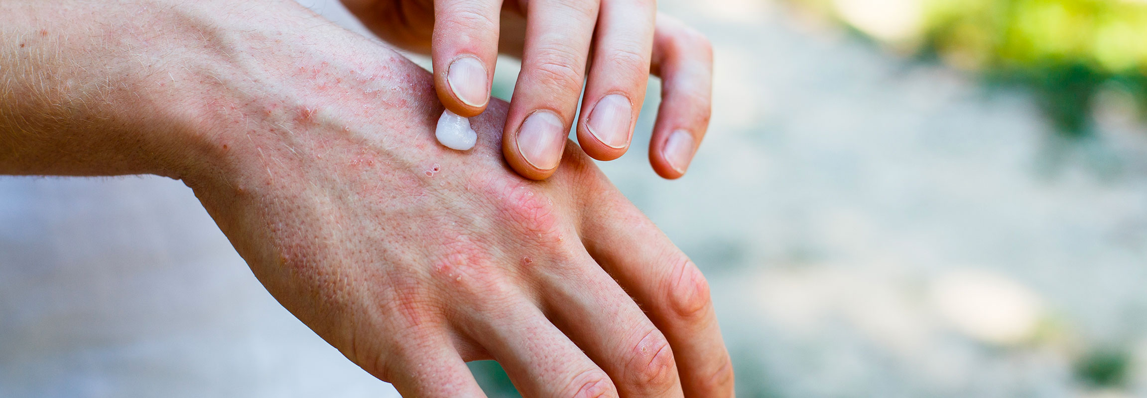 Understanding Psoriasis
